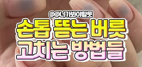 손톱뜯는버릇 고치는 방법들